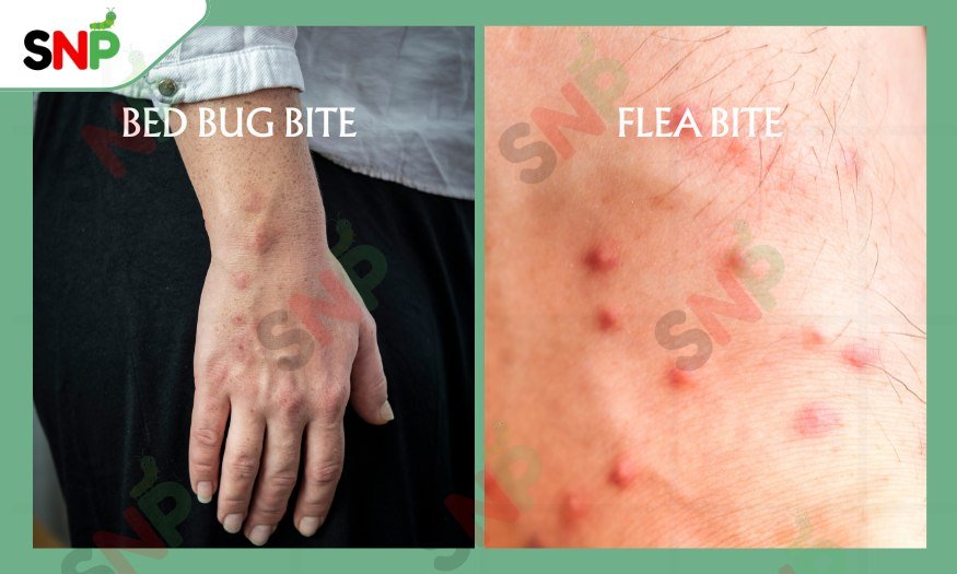 Bed-Bug-Bites-vs-Flea-Bites