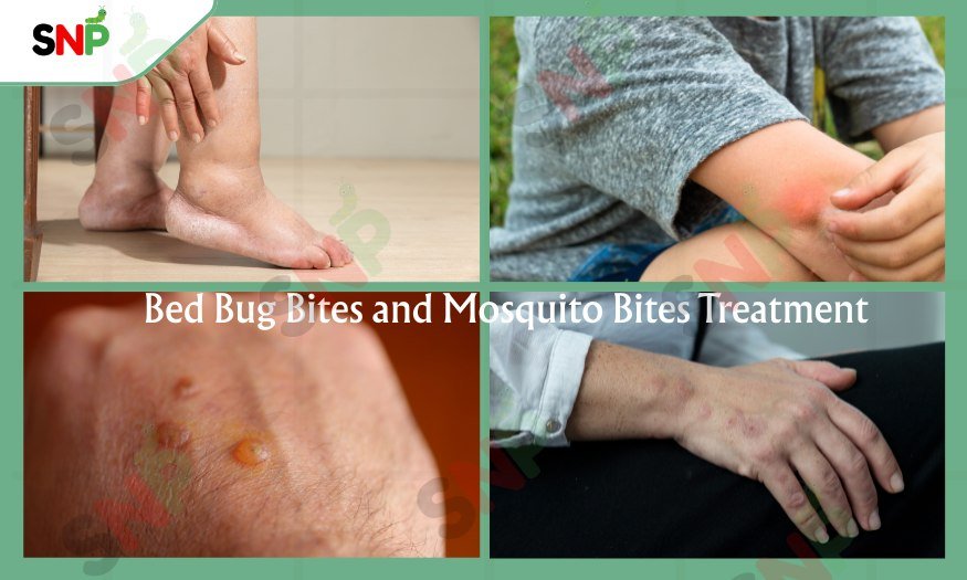 bed-bug-bites-and-mosquito-bites-treatment