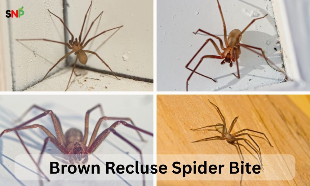 Brown-Recluse-Spider-Bite